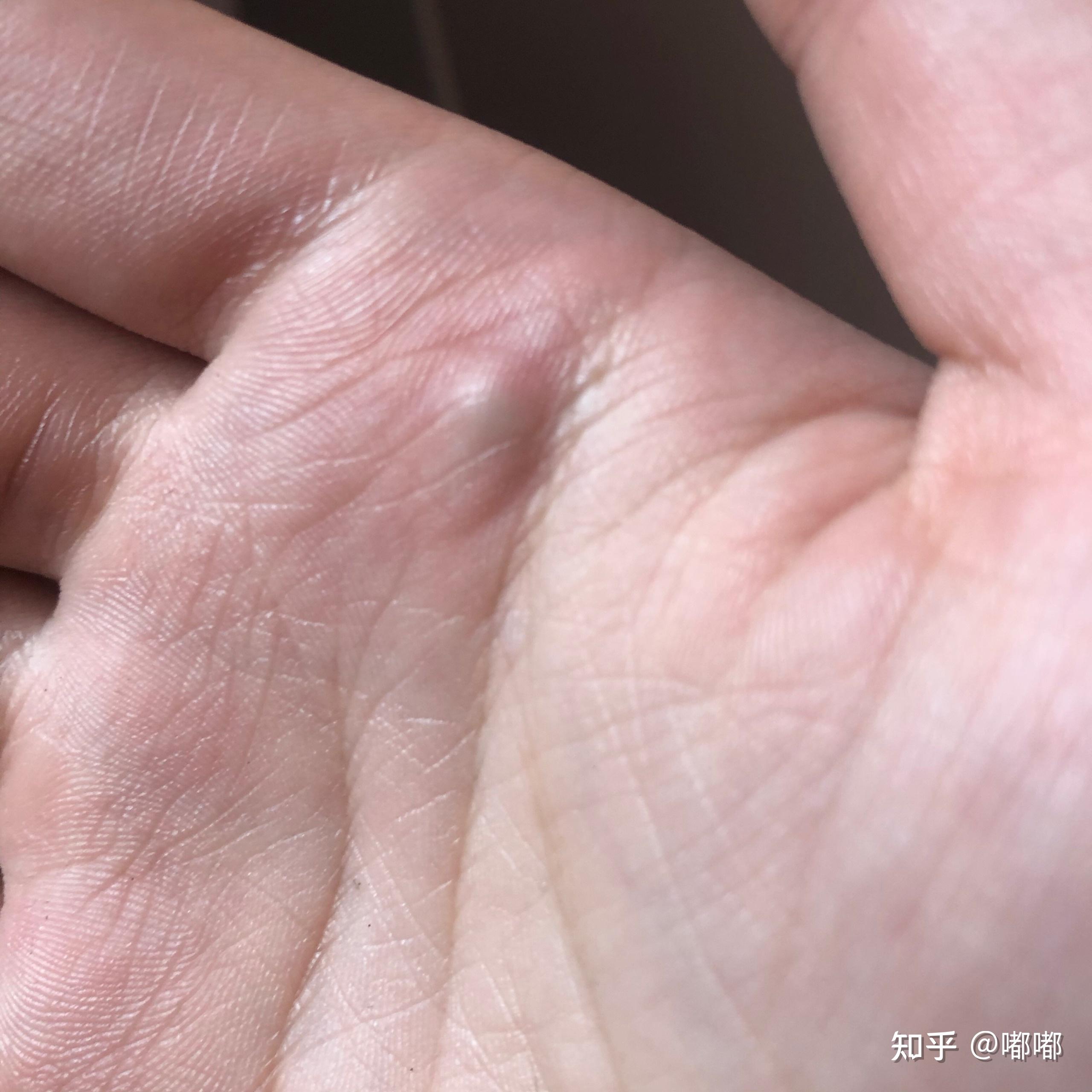 手指虎口疼是怎么回事手指虎-第2张图片