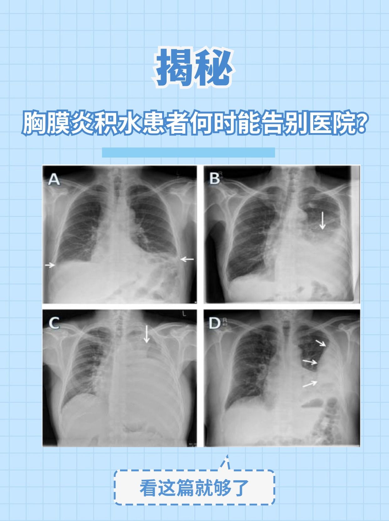 用胸膜真的可以丰胸吗胸膜奶膜刺激视频揭秘-第1张图片
